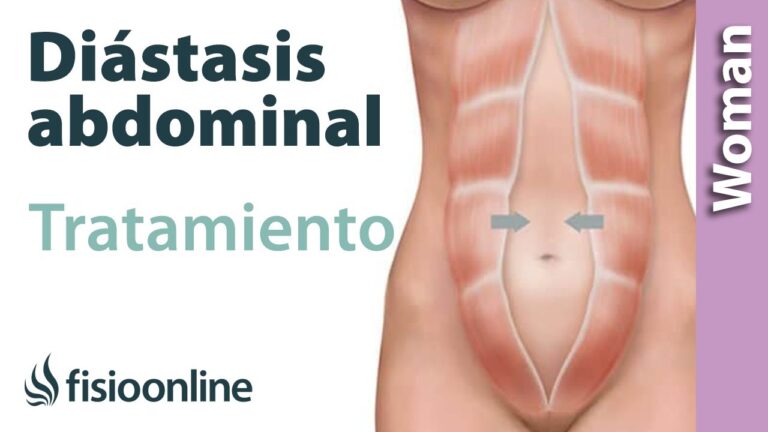 Que es diastasis abdominal