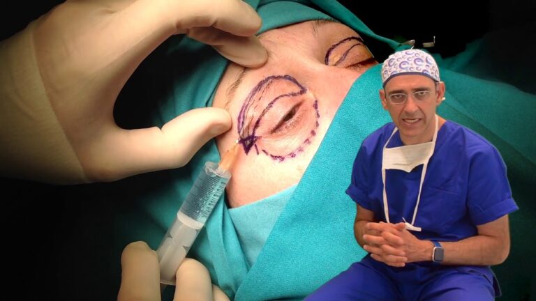 Operacion de blefaroplastia superior