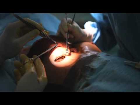 Implantes de pecho anatomicos