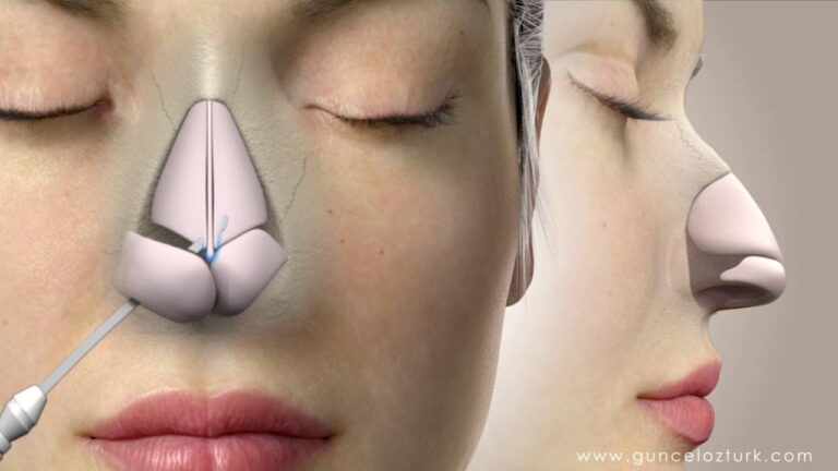 Operacion de la nariz