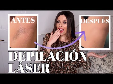 Opiniones depilacion laser
